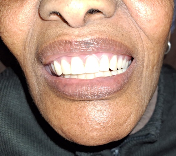 A patient who installed dentures